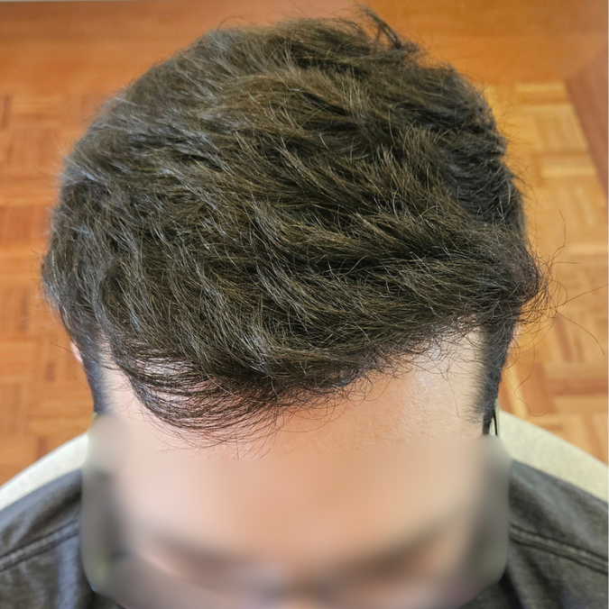 Transplante capilar masculino